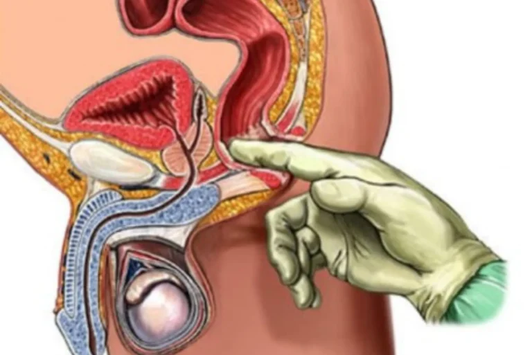 ما هي أعراض التهاب البروستاتا