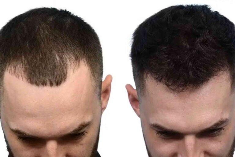 Best Hair Transplat Turkey